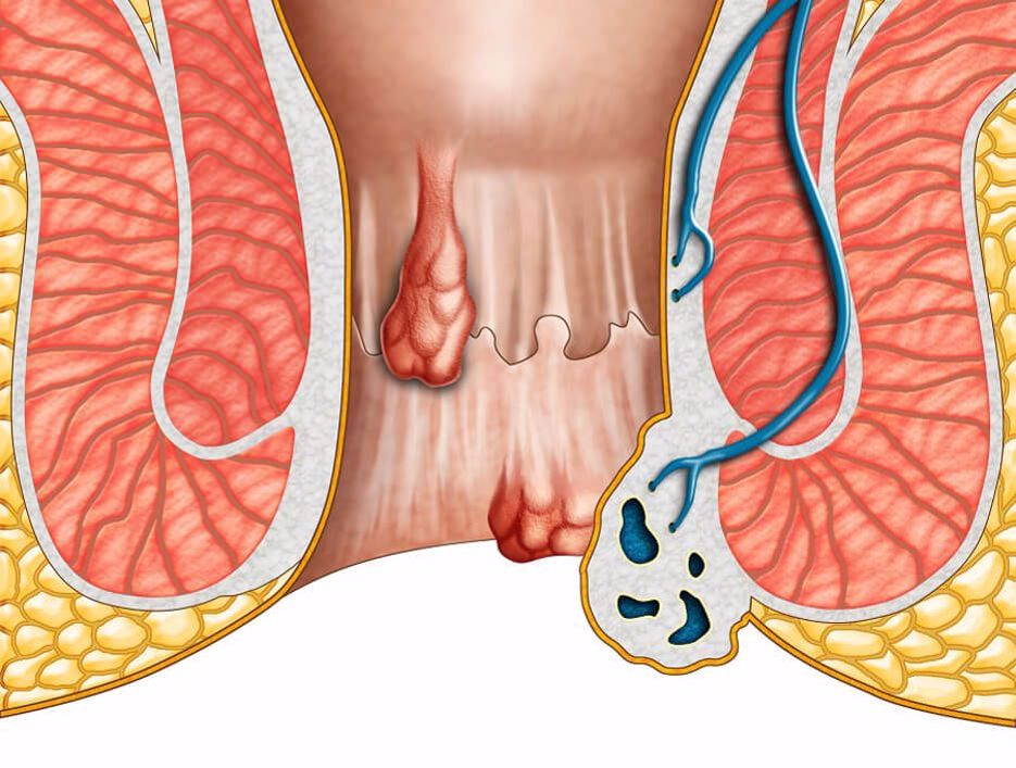 Hämorrhoiden sind nicht peinlich!